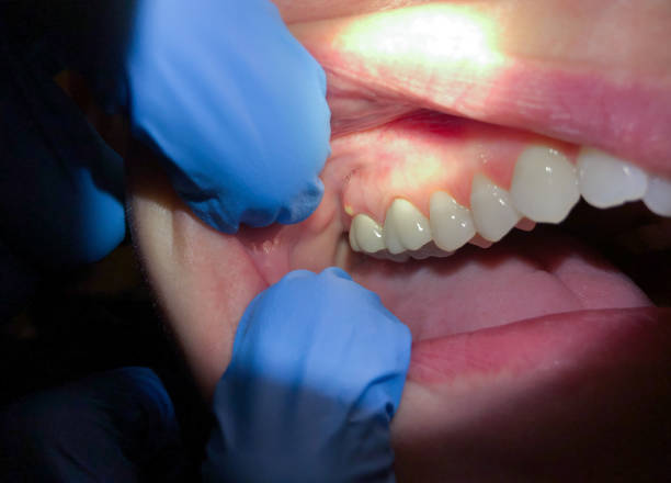 Best Emergency Denture Repair in Boyertown, PA